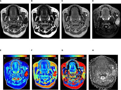 Synthetic MRI plus FSE-PROPELLER DWI for differentiating malignant from benign head and neck tumors: a preliminary study